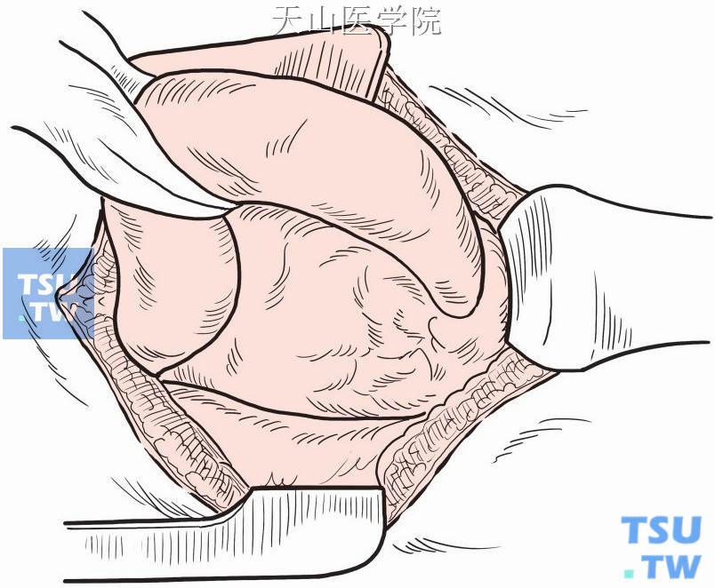 疝囊返纳回腹部