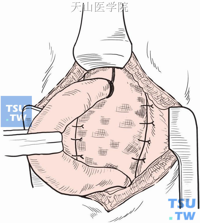 补片的下缘与腹股沟韧带做连续缝合