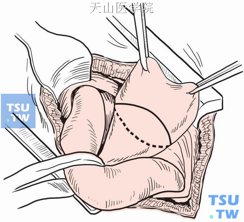 疝囊颈部的腹横筋膜周圈切开