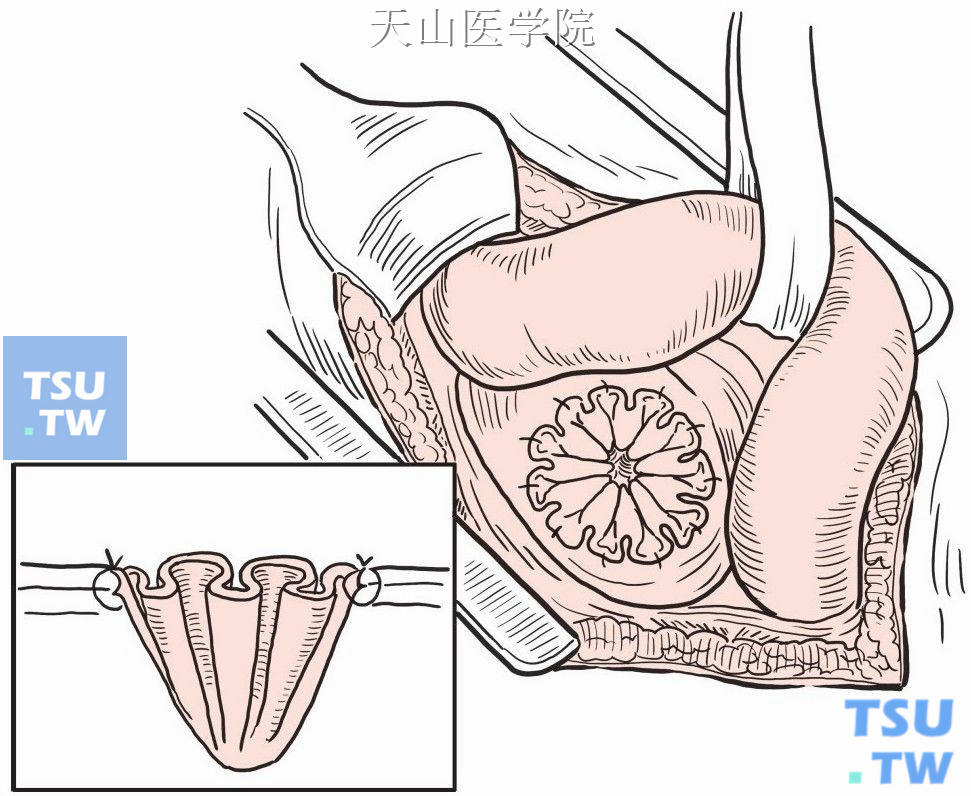 女性股疝修补术图片