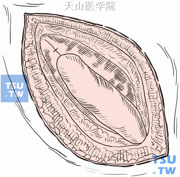 缝合固定补片