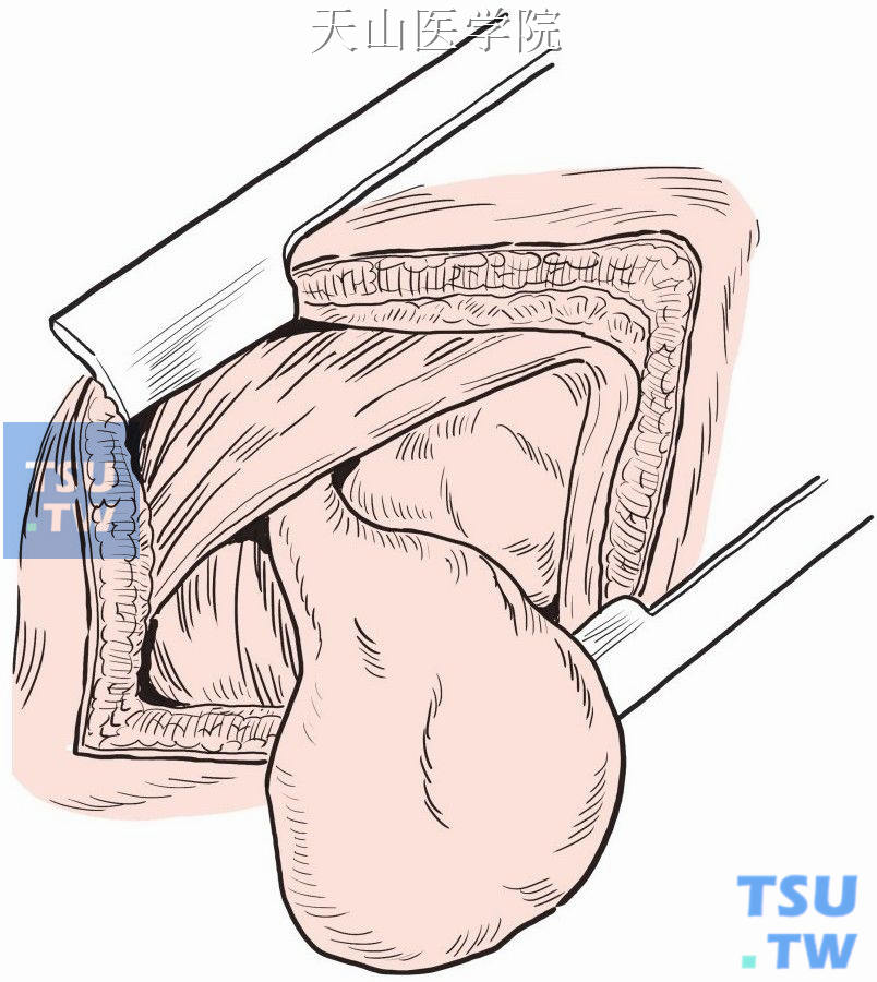 游离疝囊