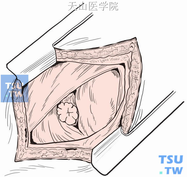 网塞置入股管，缝合固定