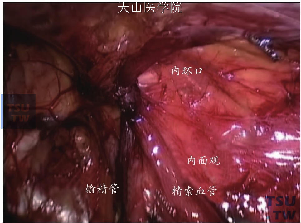 切开腹膜及分离腹膜前间隙