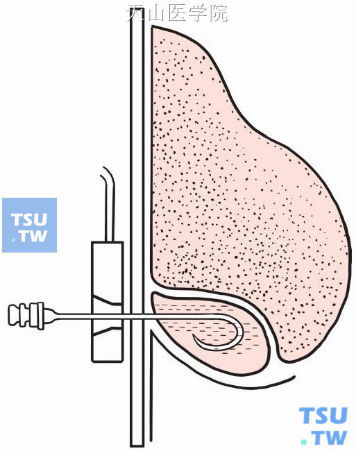 将导管前端弯曲于脓腔内