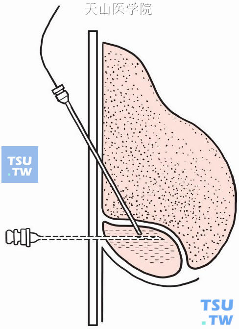 腹腔脓肿置管引流术