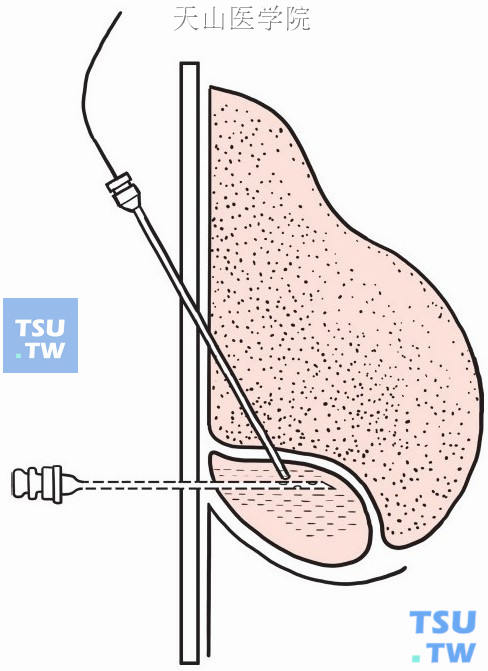 引流管沿导丝插入脓腔