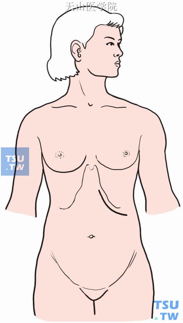 根据左侧或右侧膈下脓肿部位，沿左侧或右侧肋缘下2cm做斜切口