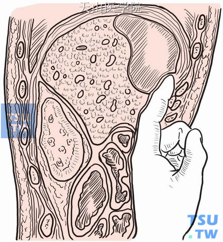 根据脓肿部位，用示指在腹膜外向右上或左上分离至炎症浸润部位
