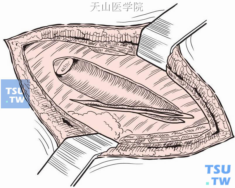 在第1腰椎棘突水平处横行切开第12肋的肋骨床。此切口切开第12肋骨骨膜的中部后，下锯肌的最下指状部分和腰方肌均位于切口的内缘。第11肋间的肋间肌则位于其外