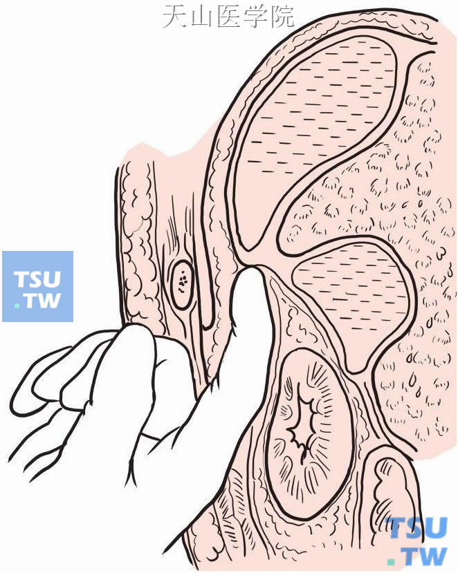 显露肝上间隙脓肿，可用手指将腹膜从膈面剥下，向上分离