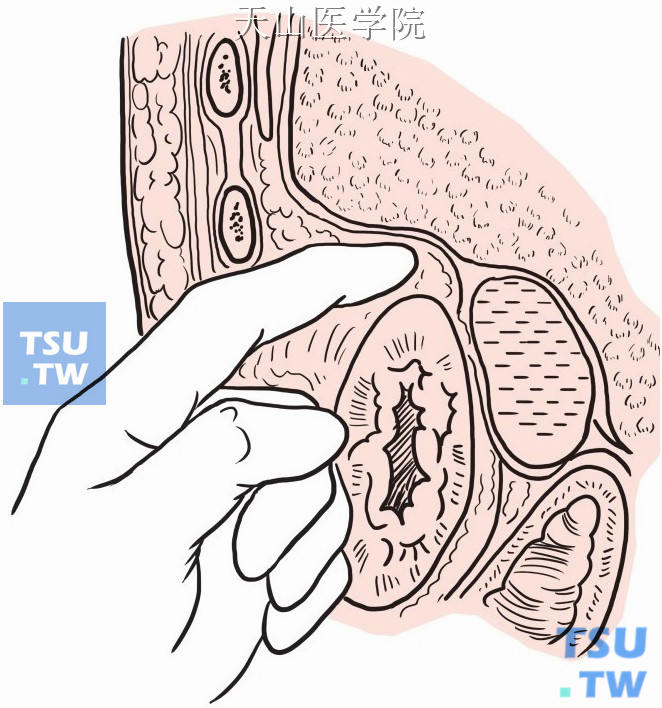 如欲探查右肝下腹膜内间隙，可用手指在肾上极之前向下分离