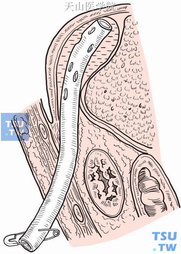 图4-3-7　脓腔试验性穿刺  脓腔则用一根或数根橡皮管引流，在切口下另戳孔引出