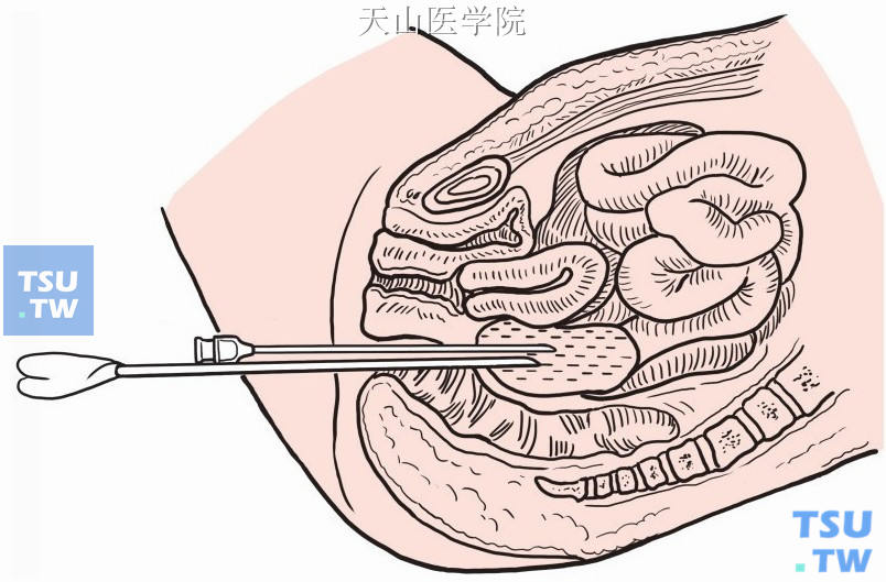 前庭大腺囊肿抽脓过程图片