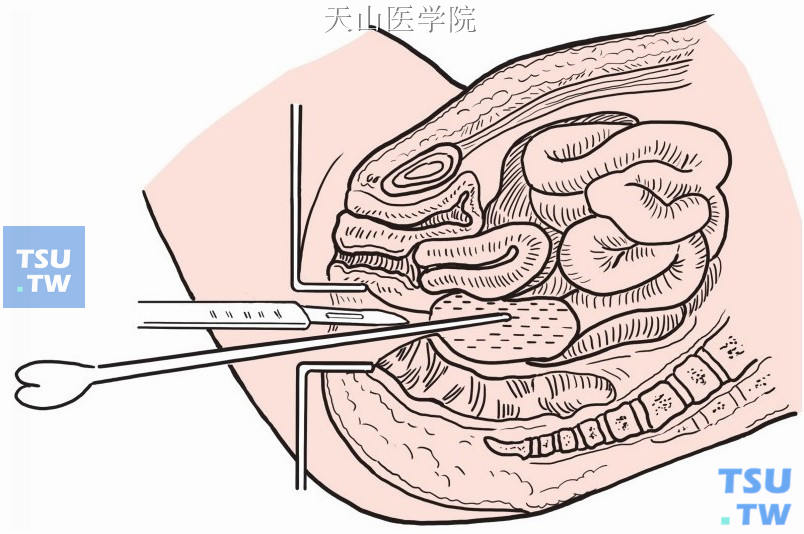 尖刀沿有槽探针切开直肠前壁，排出脓液