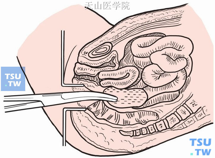 弯止血钳扩大切口