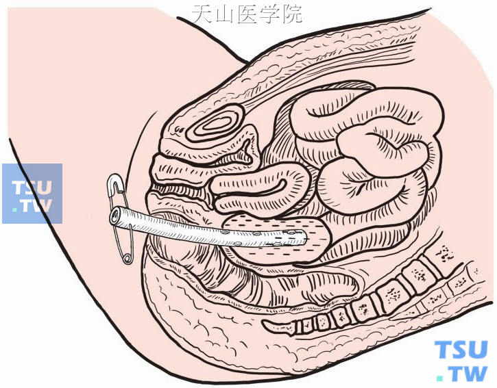 脓腔内置引流管