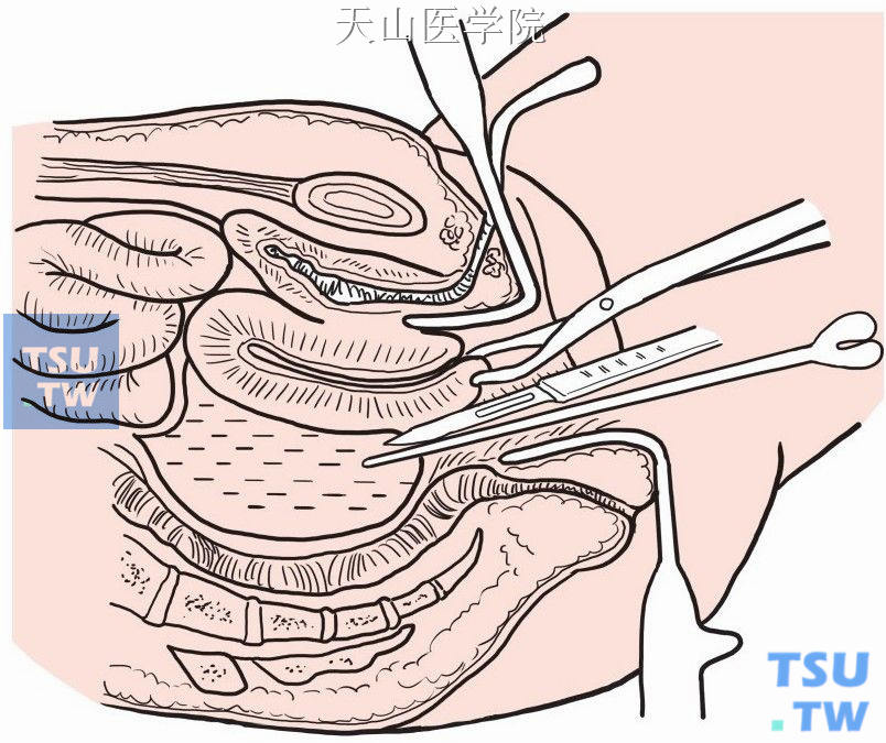 抽出脓液后保留针头，按盆腔脓肿经直肠切开引流术方法切开排脓