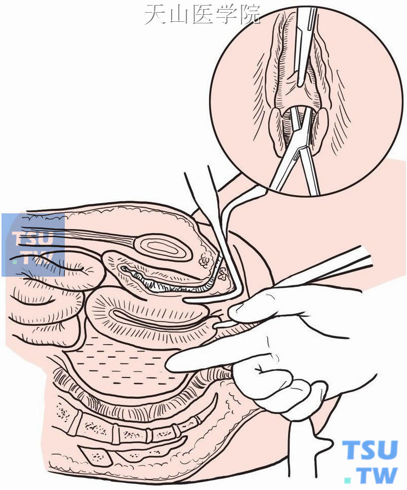 用手指伸入脓腔扩大切口并分离纤维隔