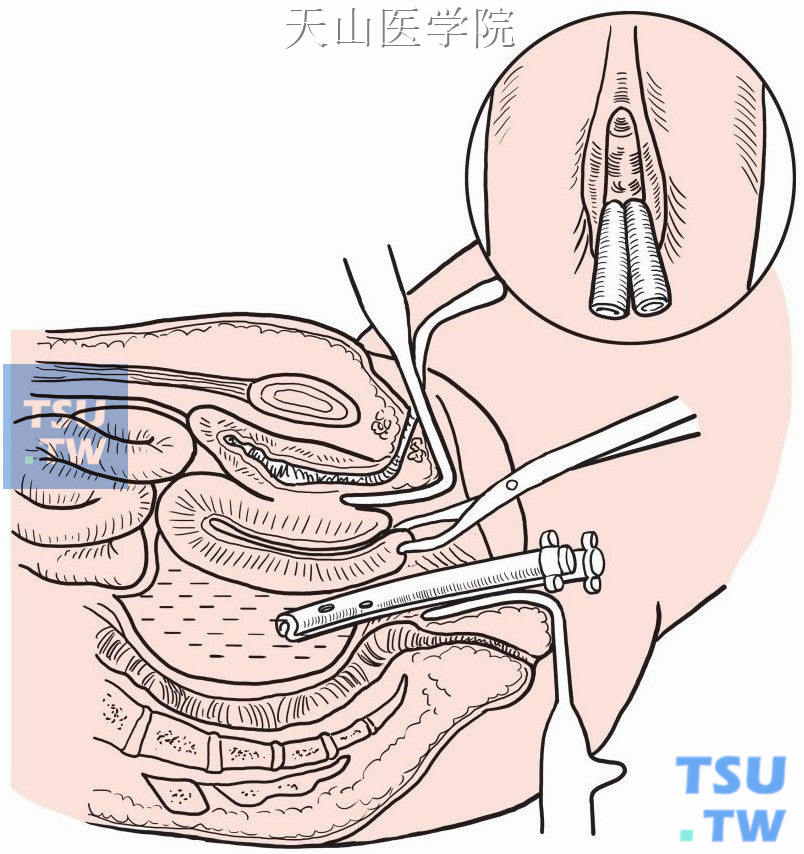 依据脓腔大小放置引流管