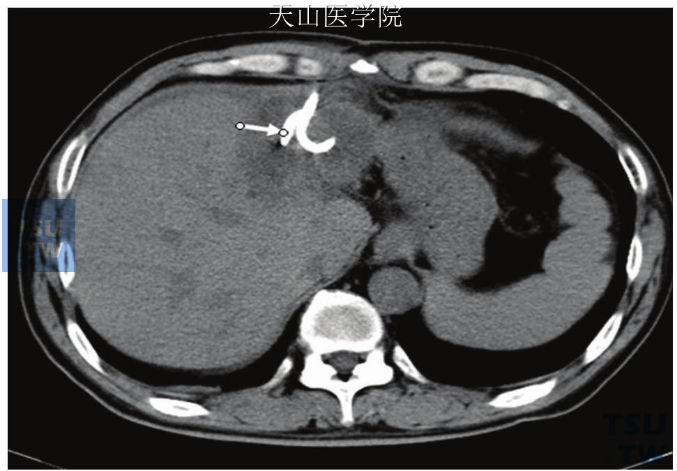 腹腔脓肿CT引导下穿刺置管引流术