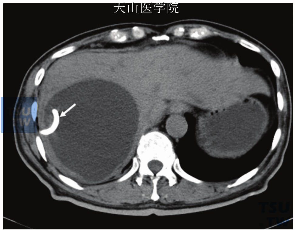 导管位于脓腔内