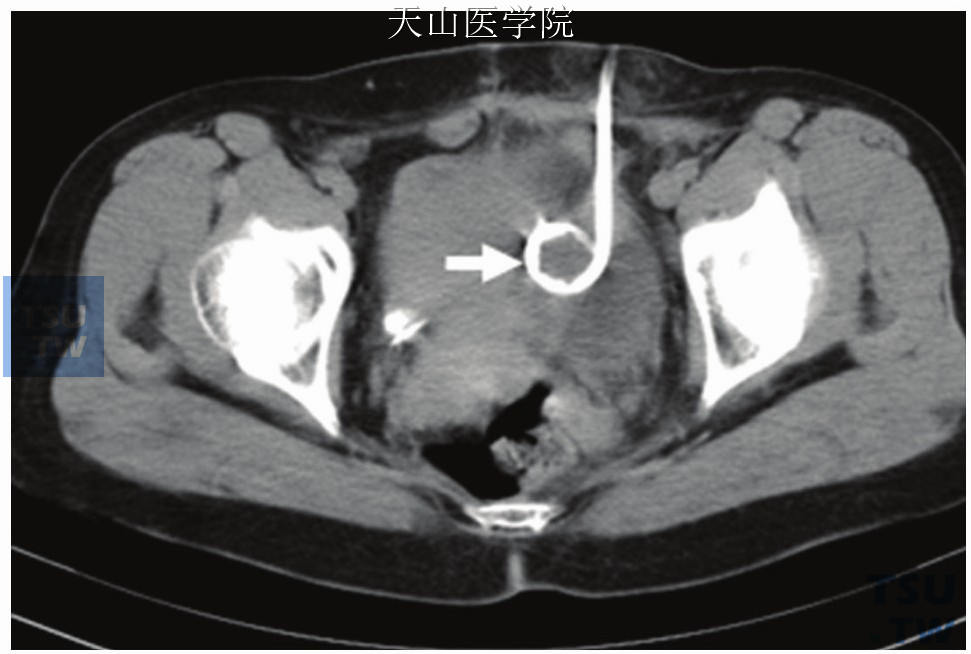 盆腔脓肿，箭头示猪尾导管位于脓腔内