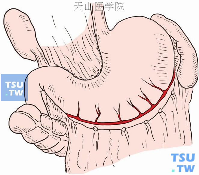 大弯血管弓内分离胃结肠韧带