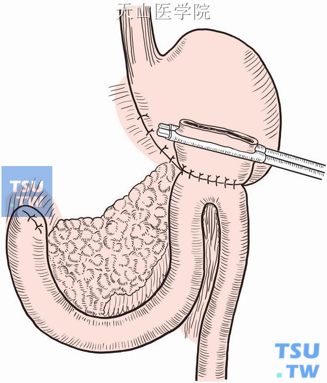 胃空肠吻合术示意图图片