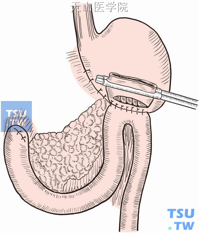 胃远端大部切除毕二式图片