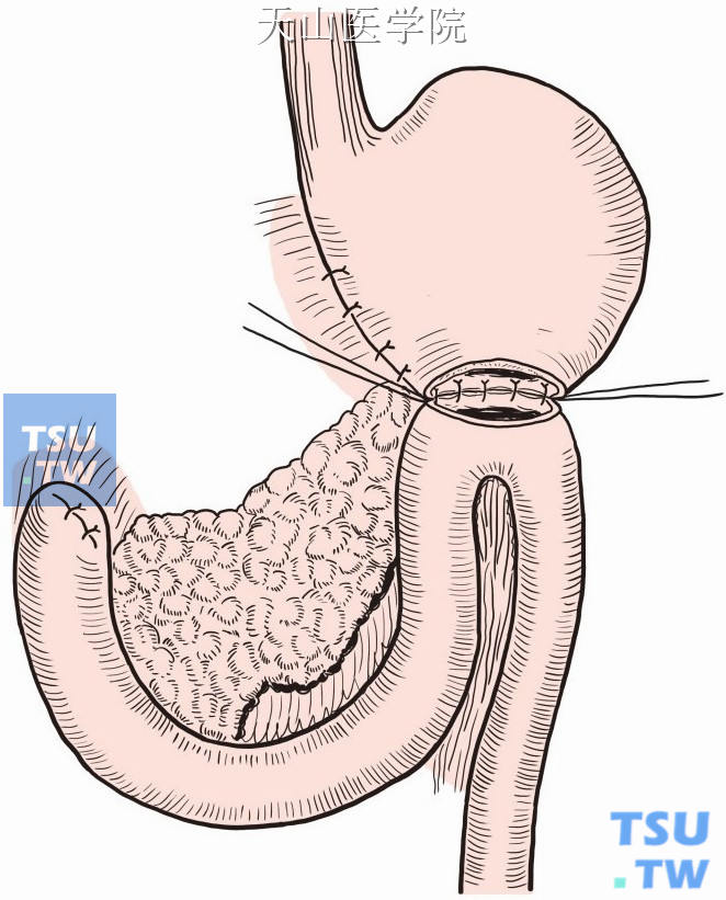 吻合口后壁缝合