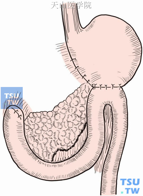胃大部切除术毕二式图片