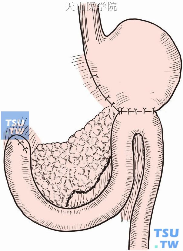 胃远端大部切除毕二式图片