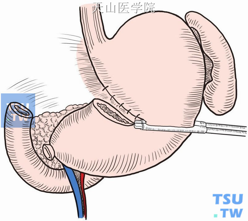 离断十二指肠，切断小弯胃壁并缝合