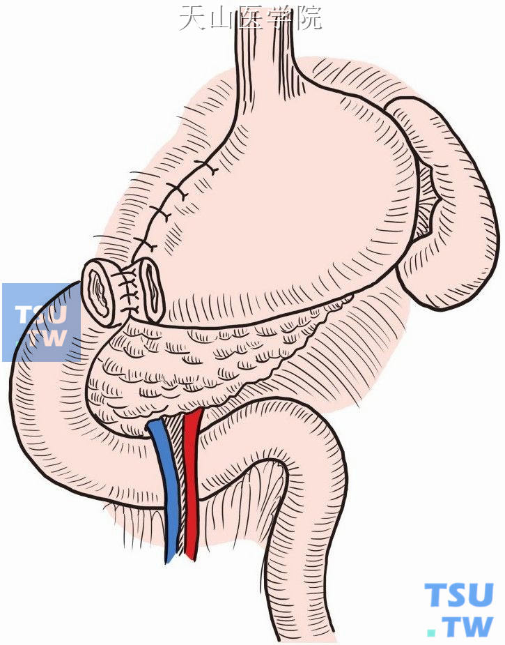 胃十二指肠后壁浆肌层缝合
