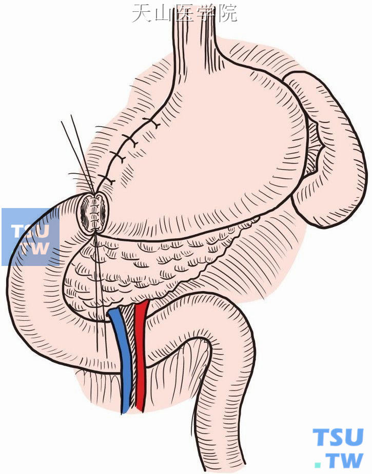 胃十二指肠后壁全层缝合