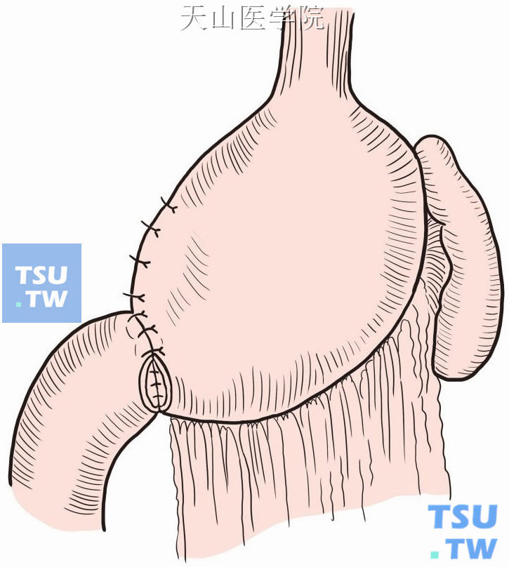 胃十二指肠前壁浆肌层缝合