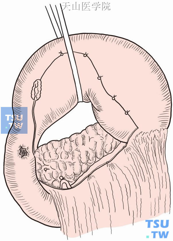 游离溃疡近端十二指肠及远端胃