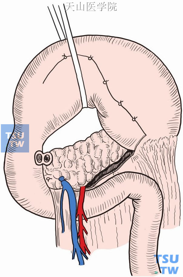 游离十二指肠、溃疡基底留在胰腺表面