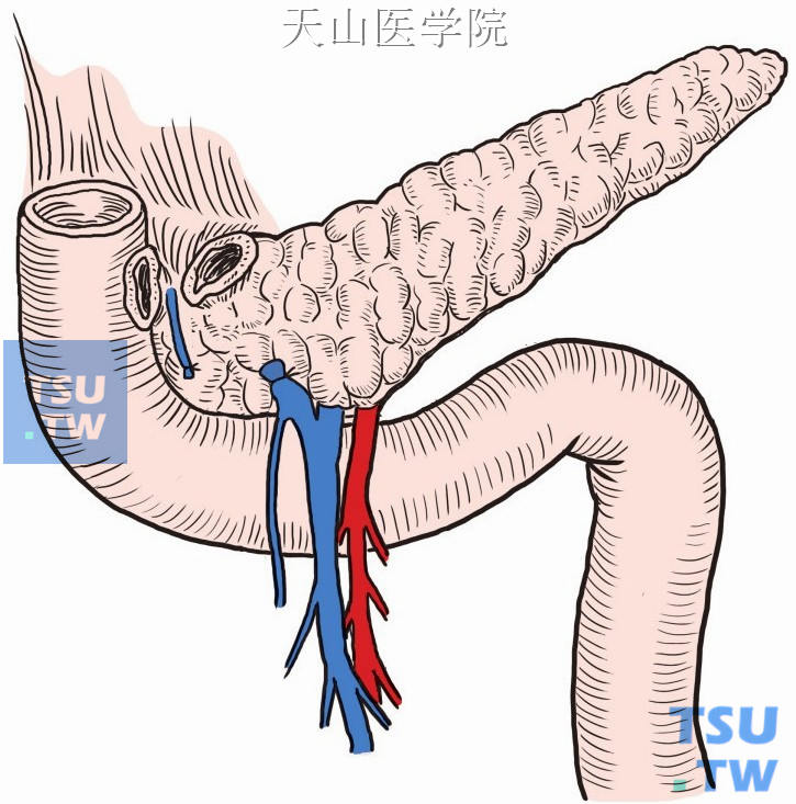 十二指肠后壁从胰腺表面瘢痕远侧分离