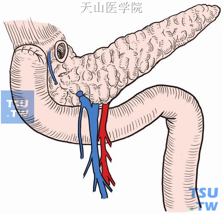 闭合十二指肠残端