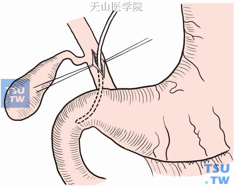 切开胆总管置入导管