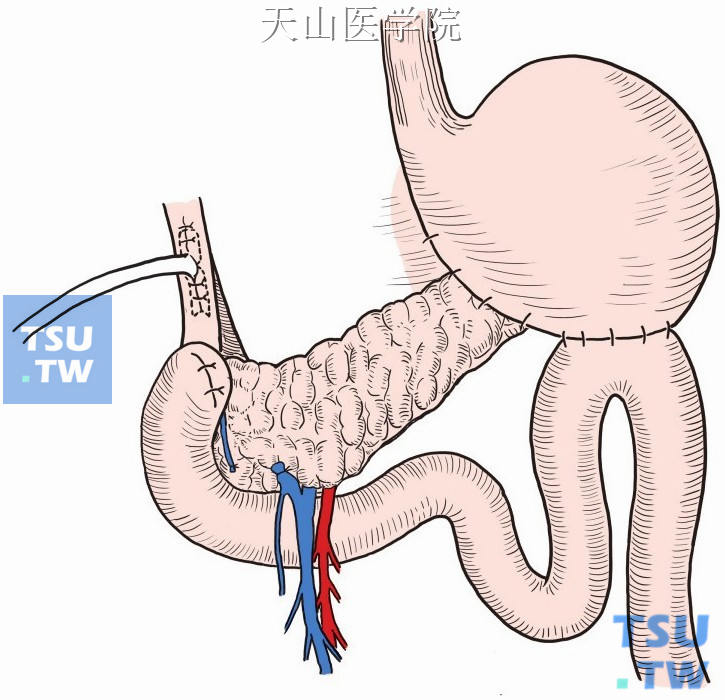 处理十二指肠残端后胆总管“T”形管引流