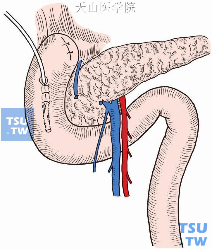 十二指肠降部置入引流管