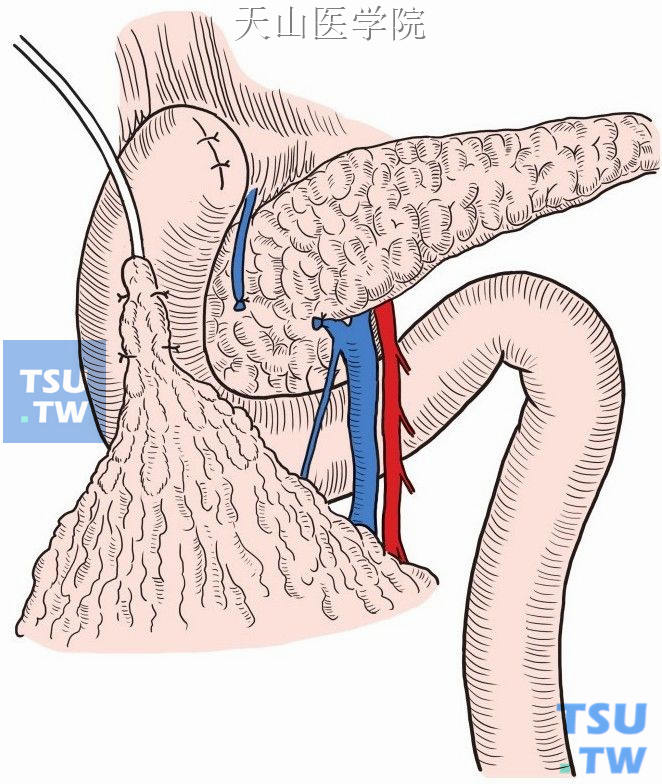 引流管经十二指肠壁处网膜覆盖