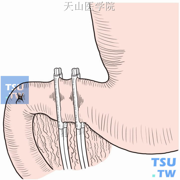 距幽门5cm处离断胃窦