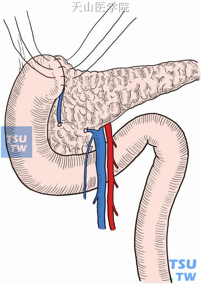 十二指肠前壁再缝于胰包膜上