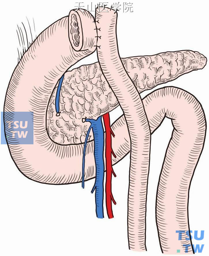 空肠与十二指肠残端后壁浆肌层缝合