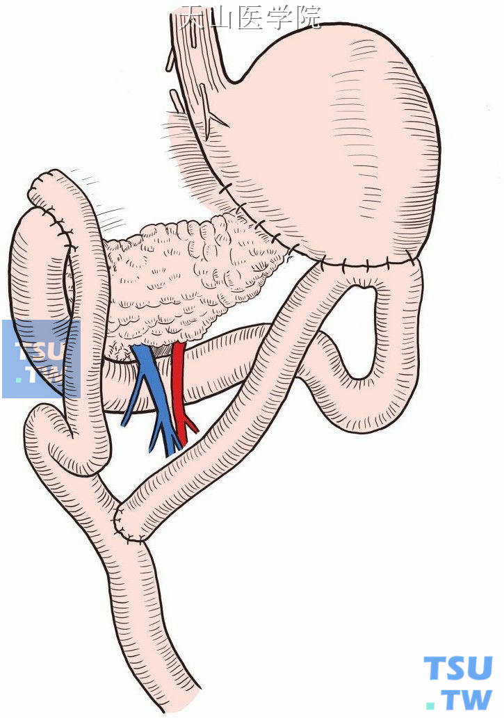 近端空肠断端与距十二指肠空肠吻合口50cm处做端侧吻合
