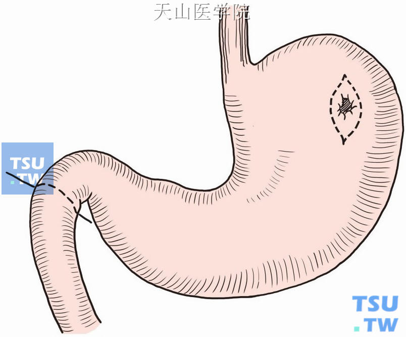 切除高位胃溃疡